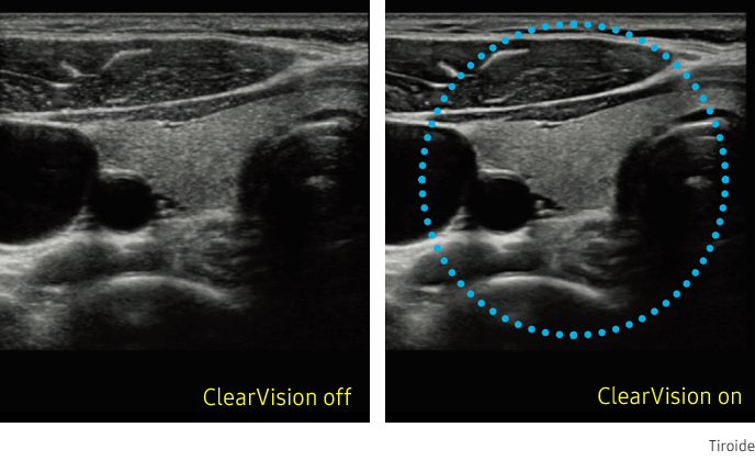 Immagine clinica della tiroide ottenuta con ClearVision