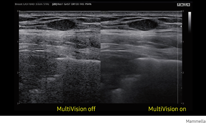 Immagine clinica della mammella ottenuta con software MultiVision