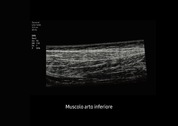 Immagine clinica del muscolo dell'arto inferiore