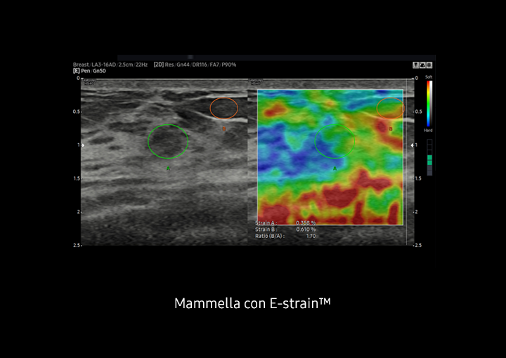Immagine clinica di un fantoccio della mammella con Elastoscan