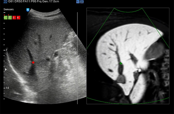  localizzazione simultanea di una lesione con un’ecografia in tempo reale e altre modalità di imaging volumetrico 3D