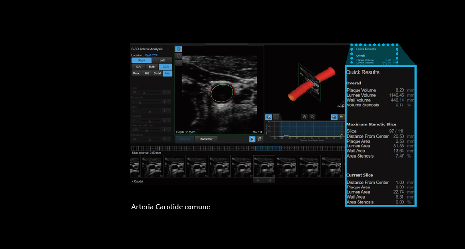 S-3D Arterial Analysis™