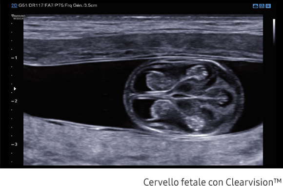 Immagine clinica del cervello fetale ottenuta con software Clearvision™