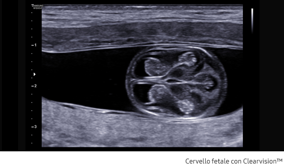 Immagine clinica del cervello fetale ottenuta con software Clearvision™