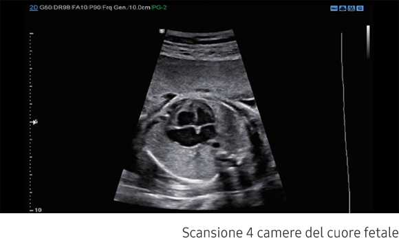 Immagini cliniche delle 4 camere del cuore fetale ottenute con software S-Harmonic™