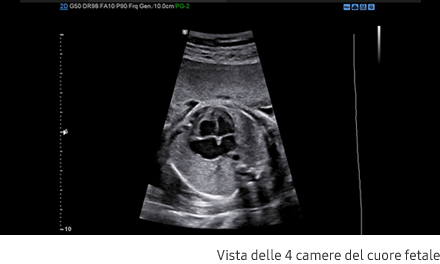 Immagini cliniche delle 4 camere del cuore fetale ottenute con software S-Harmonic™
