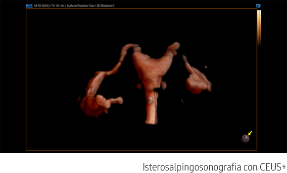 Immagine clinica di isterosalpingosonografia ottenuta con software CEUS+