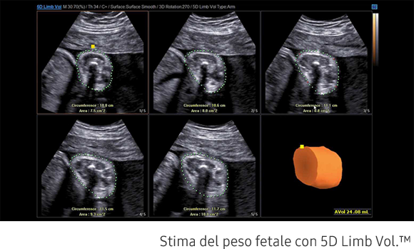 Immagine contenente una stima del peso del feto con 5D Limb Vol.™