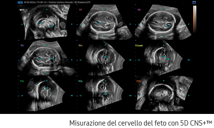 Misurazione del cervello del feto con 5D CNS+™