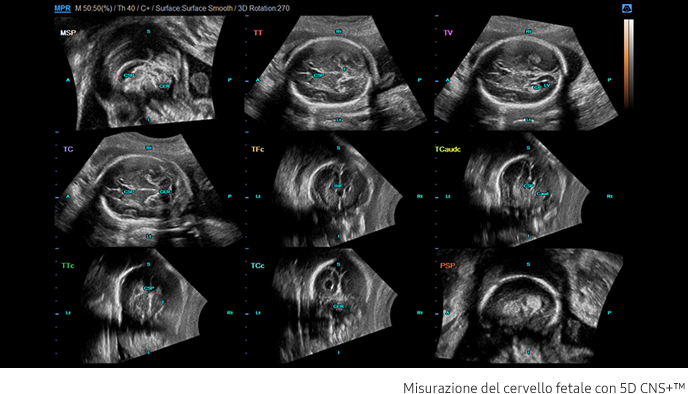Misurazione del cervello del feto con 5D CNS+™