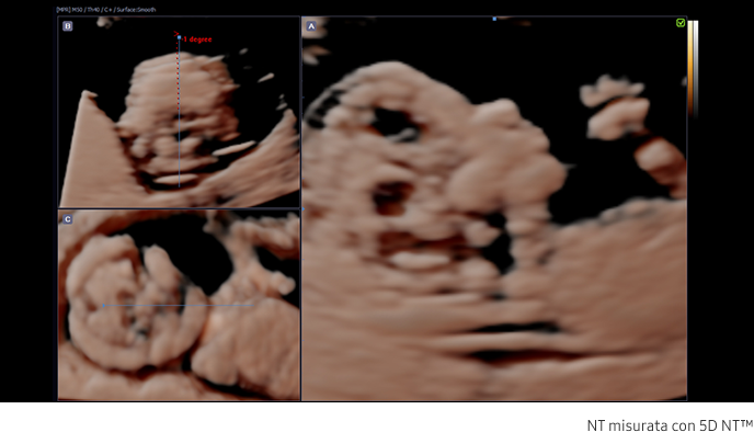 Fetal brain measurement with 5D CNS+™