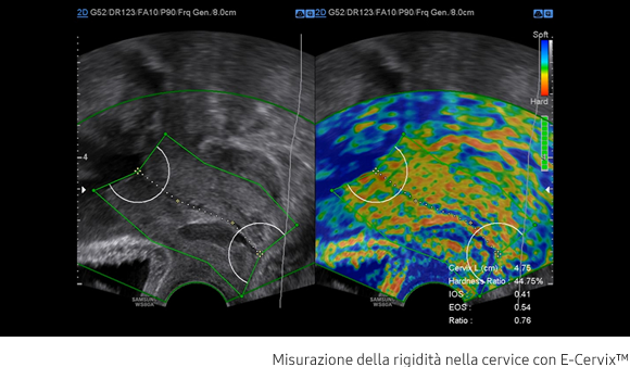 Immagine clinica rappresentante la misurazione della rigidità nella cervice con E-Cervix™
