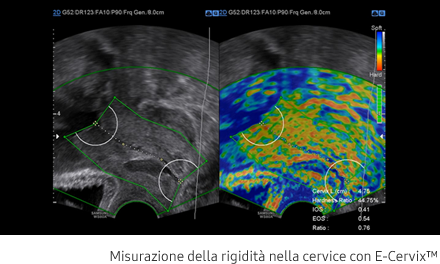 Immagine clinica rappresentante la misurazione della rigidità nella cervice con E-Cervix™