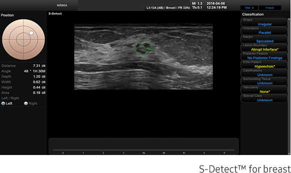 Immagine clinica ottenuta con software S-Detect™