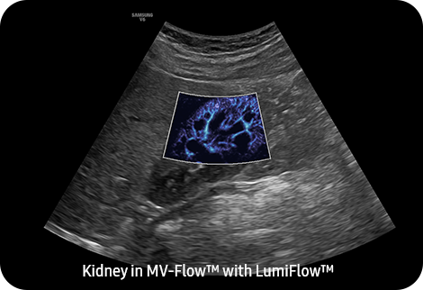 Kidney in MV-Flow™ with LumiFlow™