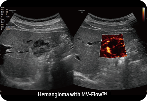 Hemangioma with MV-Flow™