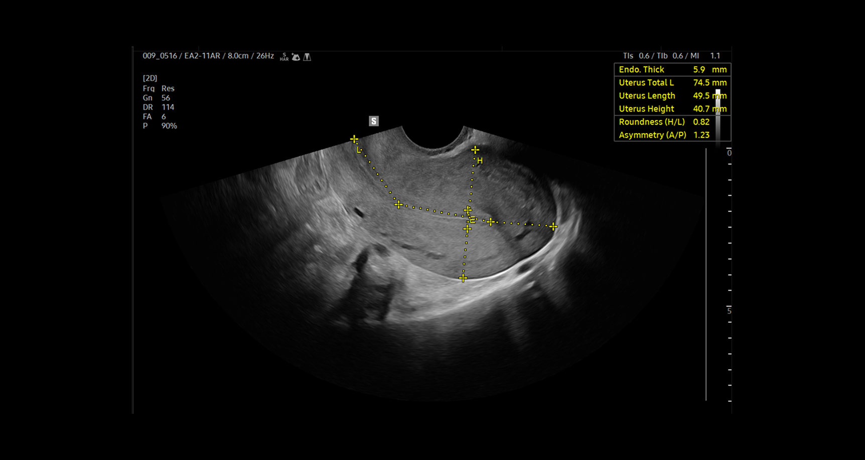 Ultrasound image of the uterus using UterineAssist showing automated measurements of uterine dimensions, endometrial thickness, and shape with yellow calipers and annotated metrics aiding in detection of abnormalities and reducing scan time