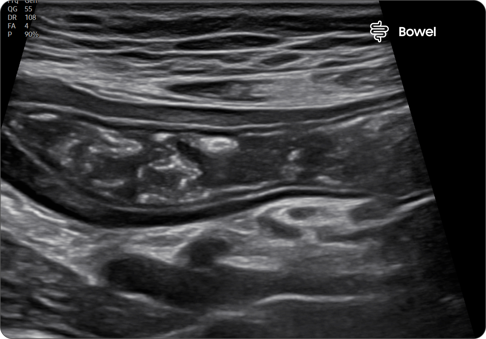 Ultrasound image of the stomach in trapezoidal view showing layered wall structure and surrounding tissue