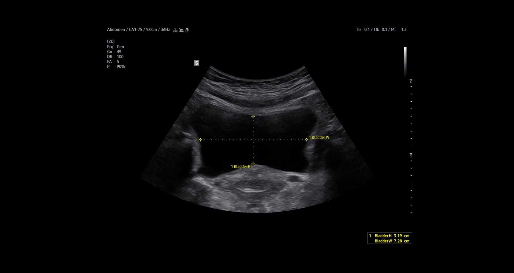  Ultrasound image of the bladder using BladderAssist showing cross-sectional view with horizontal and vertical yellow calipers measuring bladder width and height along with dimension values displayed on screen for efficient and accurate assessment