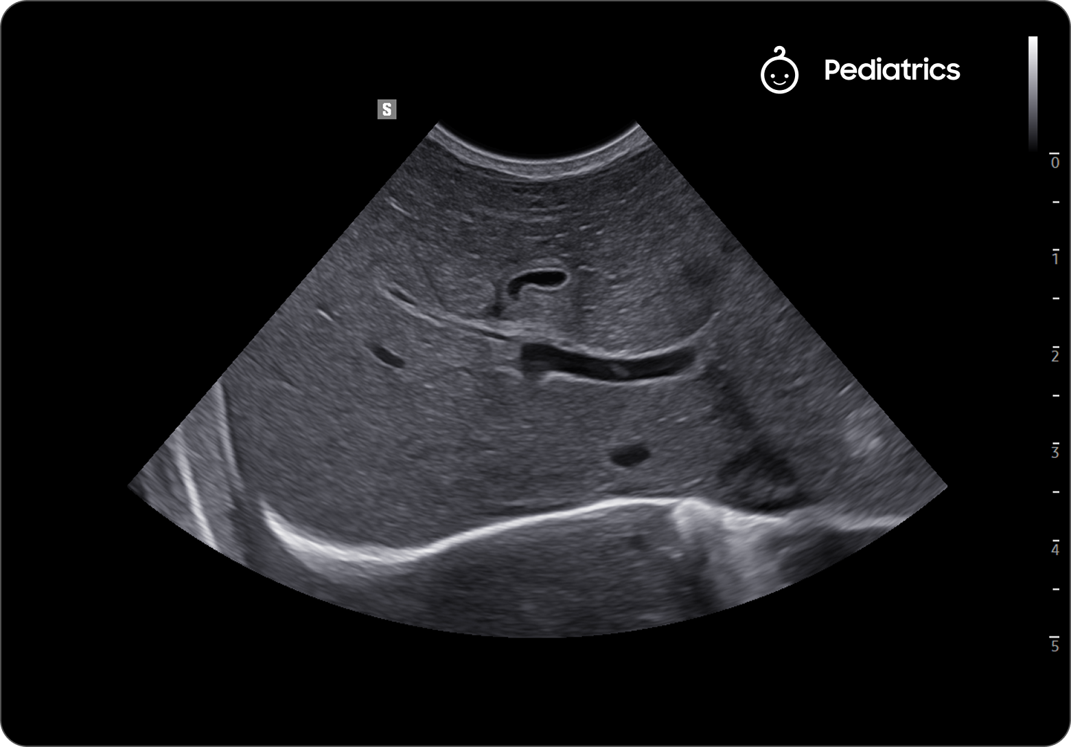 Ultrasound image of the liver showing the portal vein and hepatic structures in grayscale
