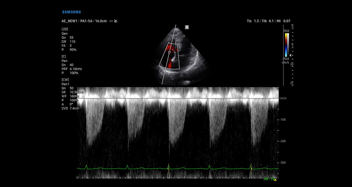 CW Mode in TR on Samsung cV Ultrasound system showing precise velocity measurement and detailed spectral display for comprehensive cardiovascular diagnostics