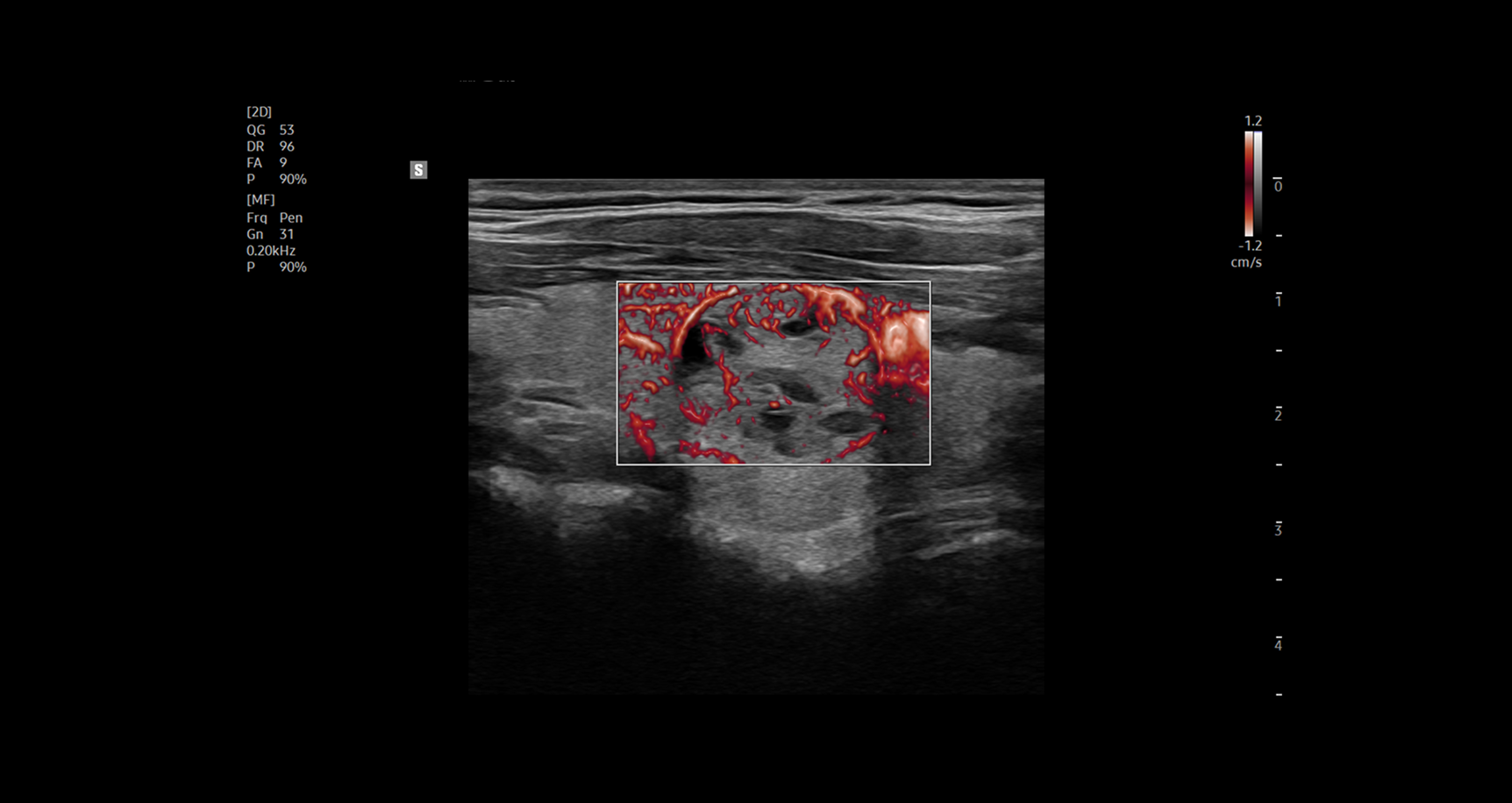 Ultrasound image showing a cross-sectional view of tissue with a rectangular region of interest displaying microvascular blood flow in red using Doppler imaging overlaid on the grayscale background