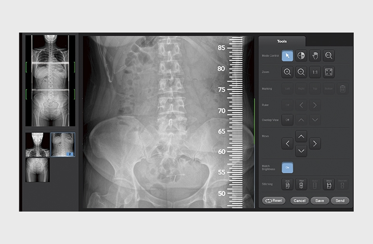 User interface demonstrating Manual Stitching function, displaying multiple spine X-ray images being aligned and combined into one complete view.