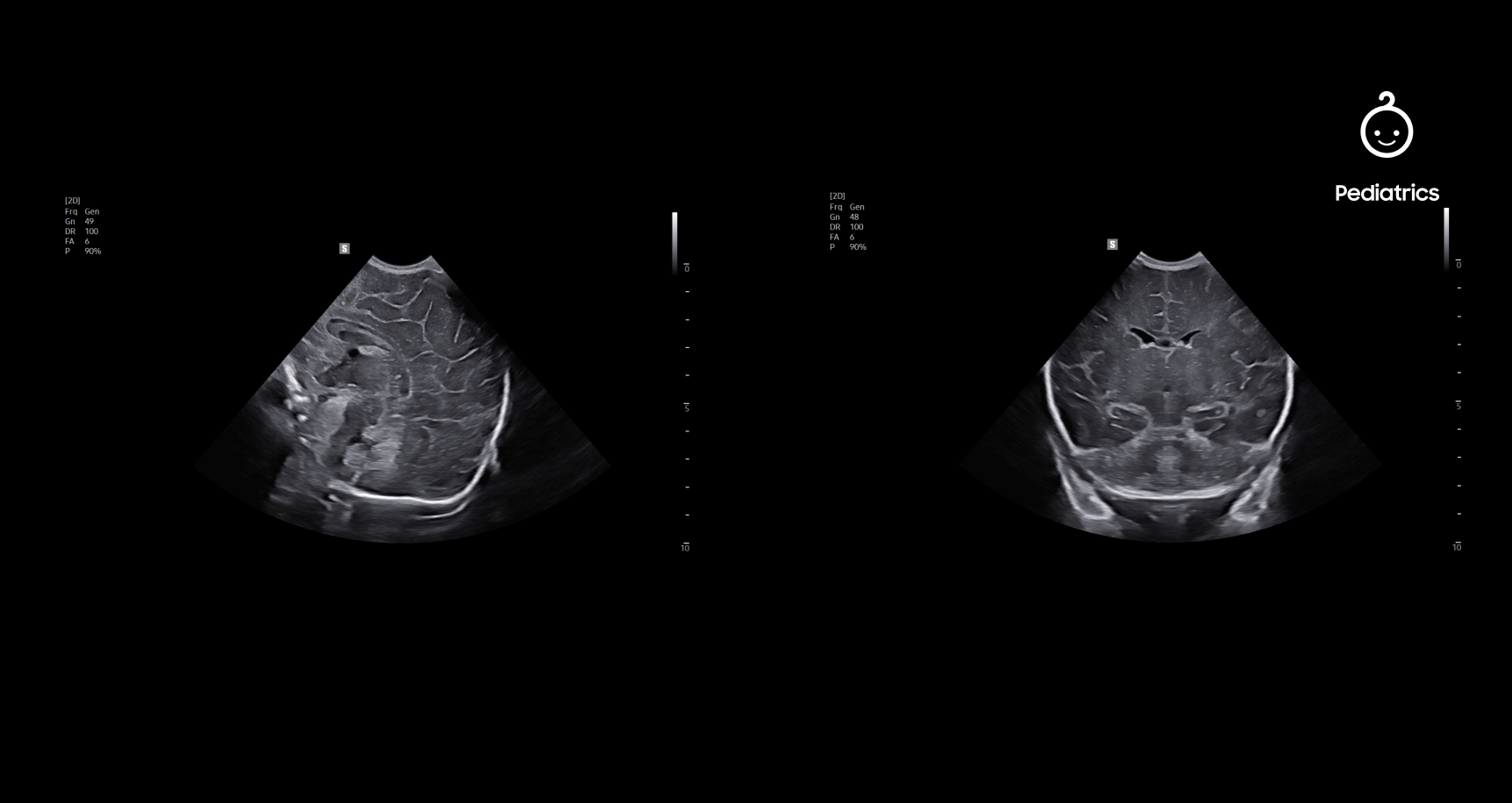 Dual-panel pediatric ultrasound images captured with the CA2-13M 3rd generation single crystal transducer showing detailed anatomical structures in grayscale for pediatric applications
