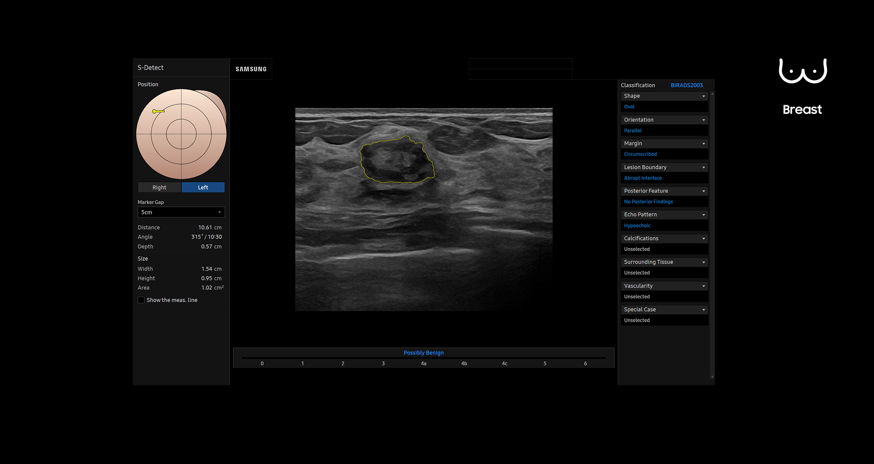 Breast ultrasound image using S-Detect showing a lesion outlined in yellow with analysis data and BI-RADS classification displayed to assist in standardized reporting and diagnosis
