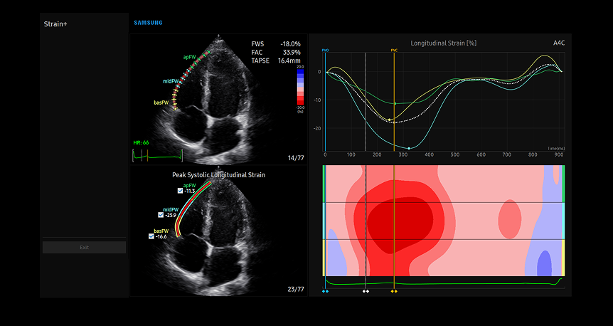 Strain+ RV cardiac imaging displaying right ventricular assessment with longitudinal strain curves and heat map visualization for detailed heart function analysis