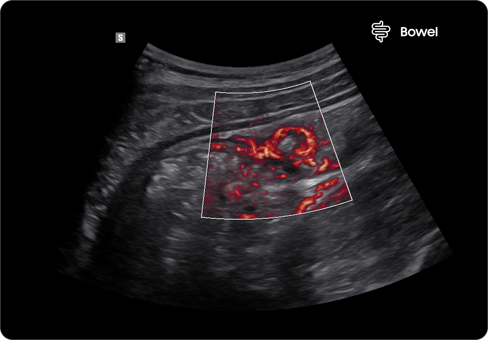 Ultrasound image of the bowel with MV-Flow highlighting inflamed areas and blood flow indicating diverticulitis