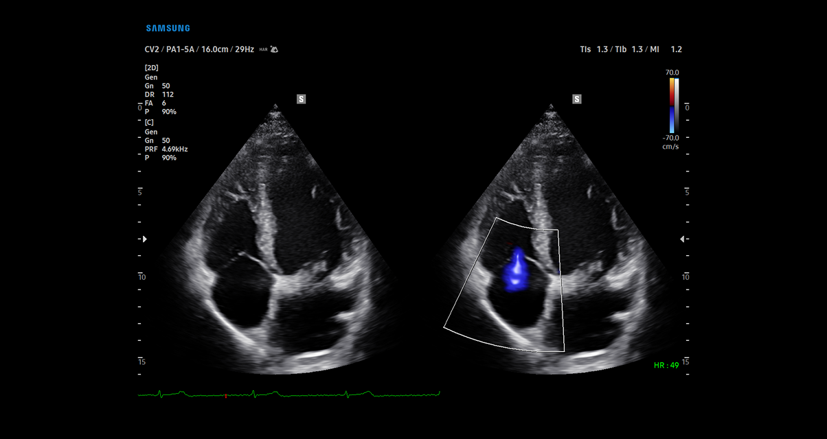 Comparative TR color with LumiFlow™ technology on Samsung cV Ultrasound demonstrating advanced cardiovascular visualization with side-by-side cardiac imaging
