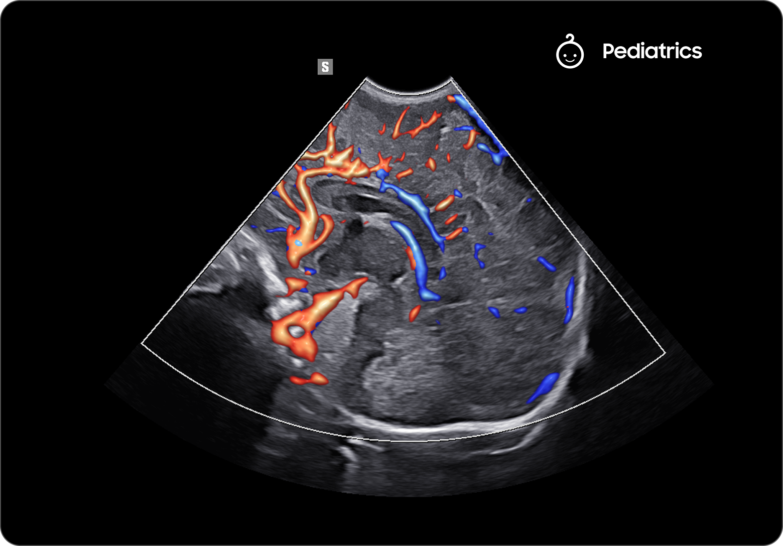 Ultrasound image of the pericallosal artery in a pediatric brain with color Doppler flow in red and blue