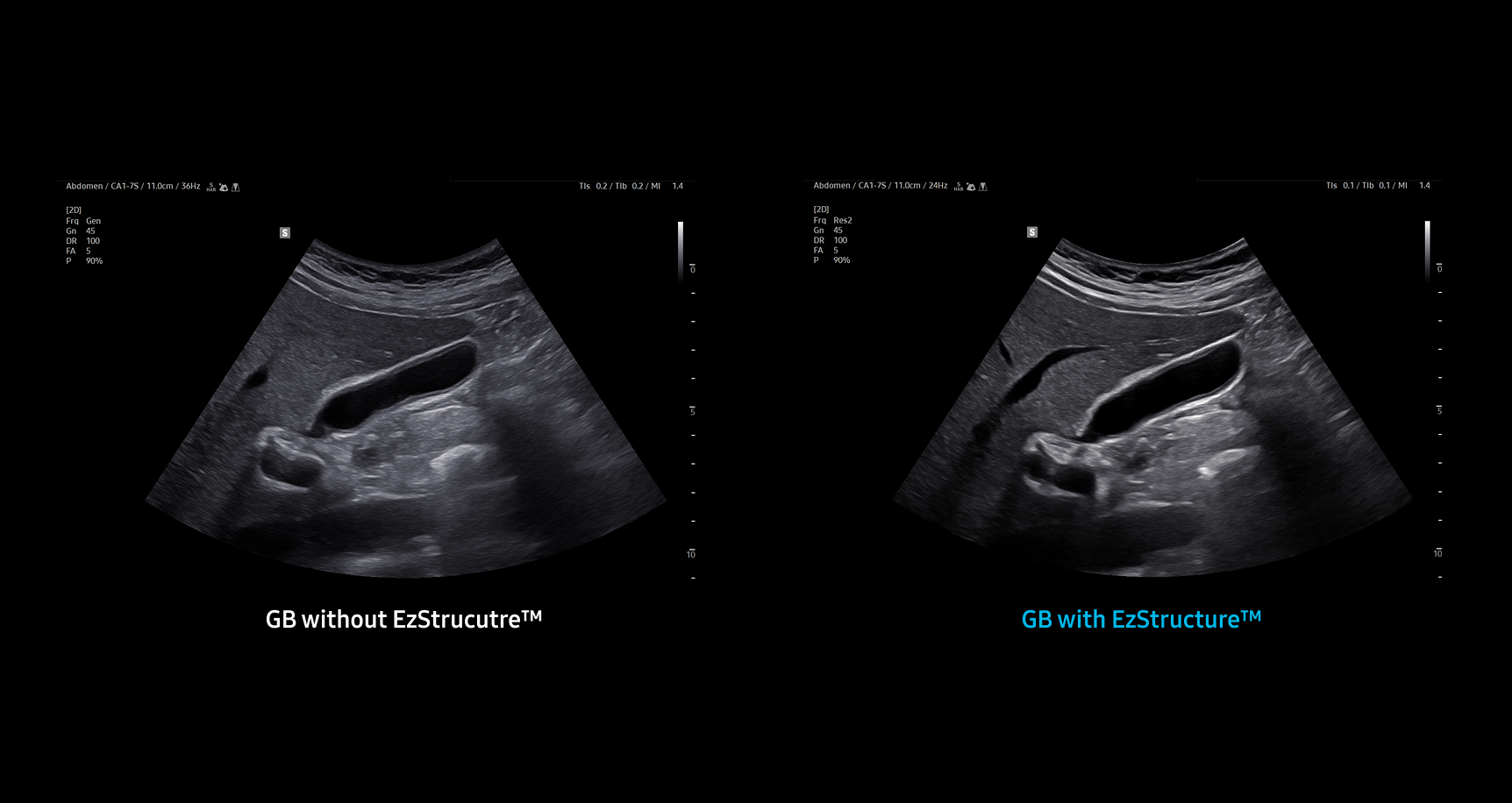 Side by side abdominal ultrasound images of the gallbladder showing GB without EzStructure on the left with lower clarity and GB with EzStructure on the right with enhanced structural definition and detail