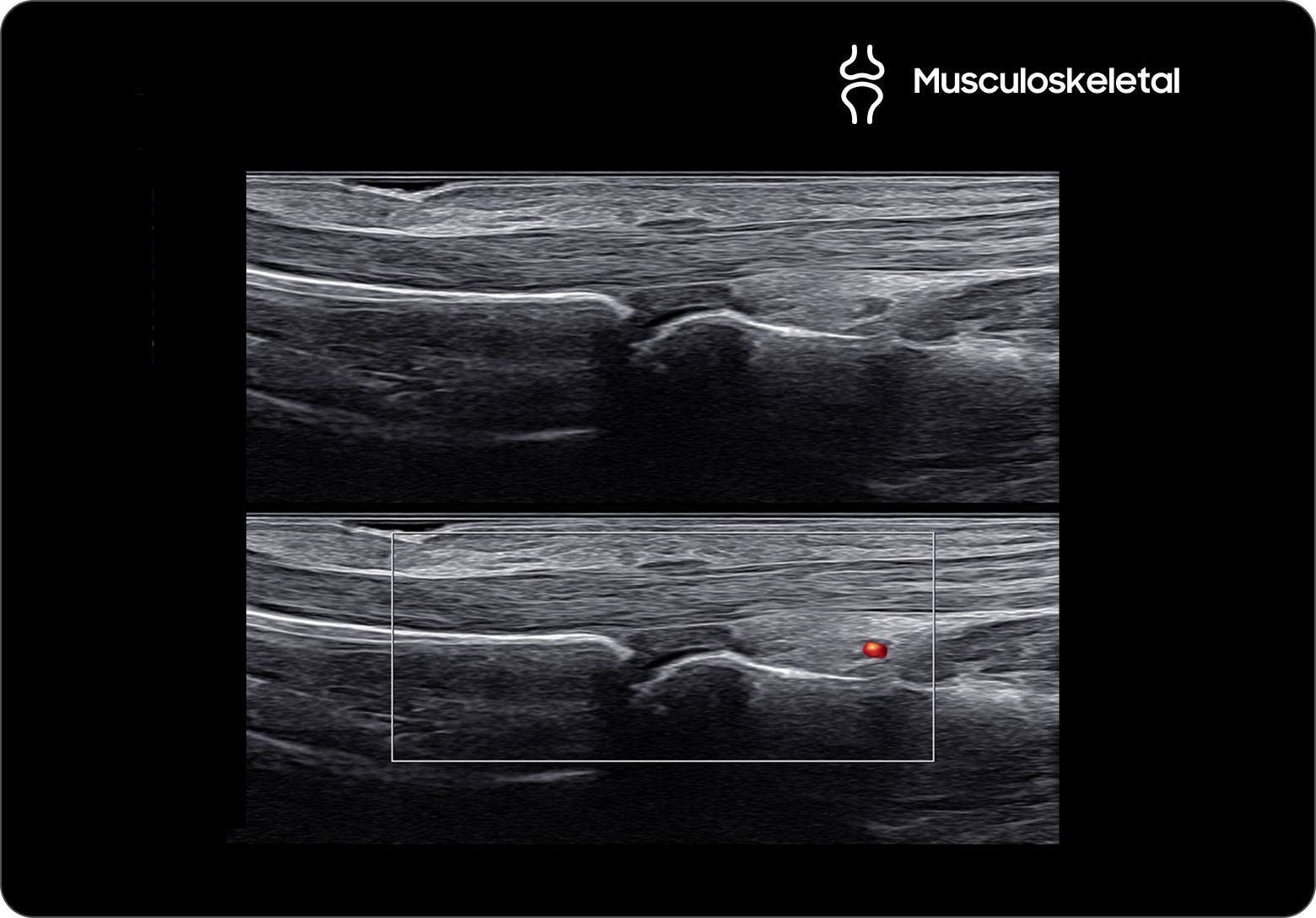 Ultrasound image of a finger with DualLive mode showing two comparative views of the soft tissue and bone