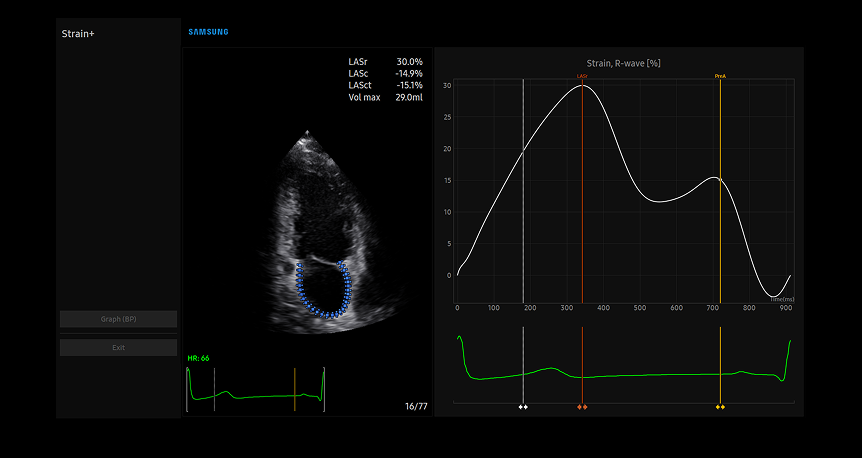 Left atrial strain assessment technology with blue-tracked myocardial movement and corresponding strain curve graph for specialized cardiac function evaluation