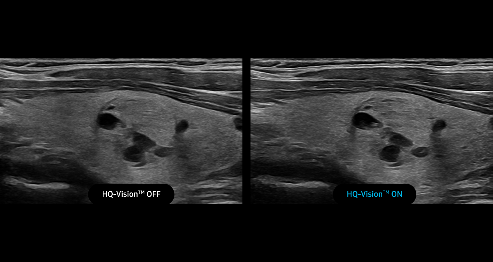 Side by side ultrasound images showing HQ-Vision OFF on the left with softer less defined structures and HQ-Vision ON on the right with sharper clearer tissue details and enhanced image resolution