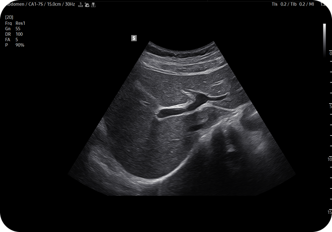 Ultrasound scan of the abdomen showing the liver and bile ducts in grayscale, with measurement and imaging settings displayed on the screen
