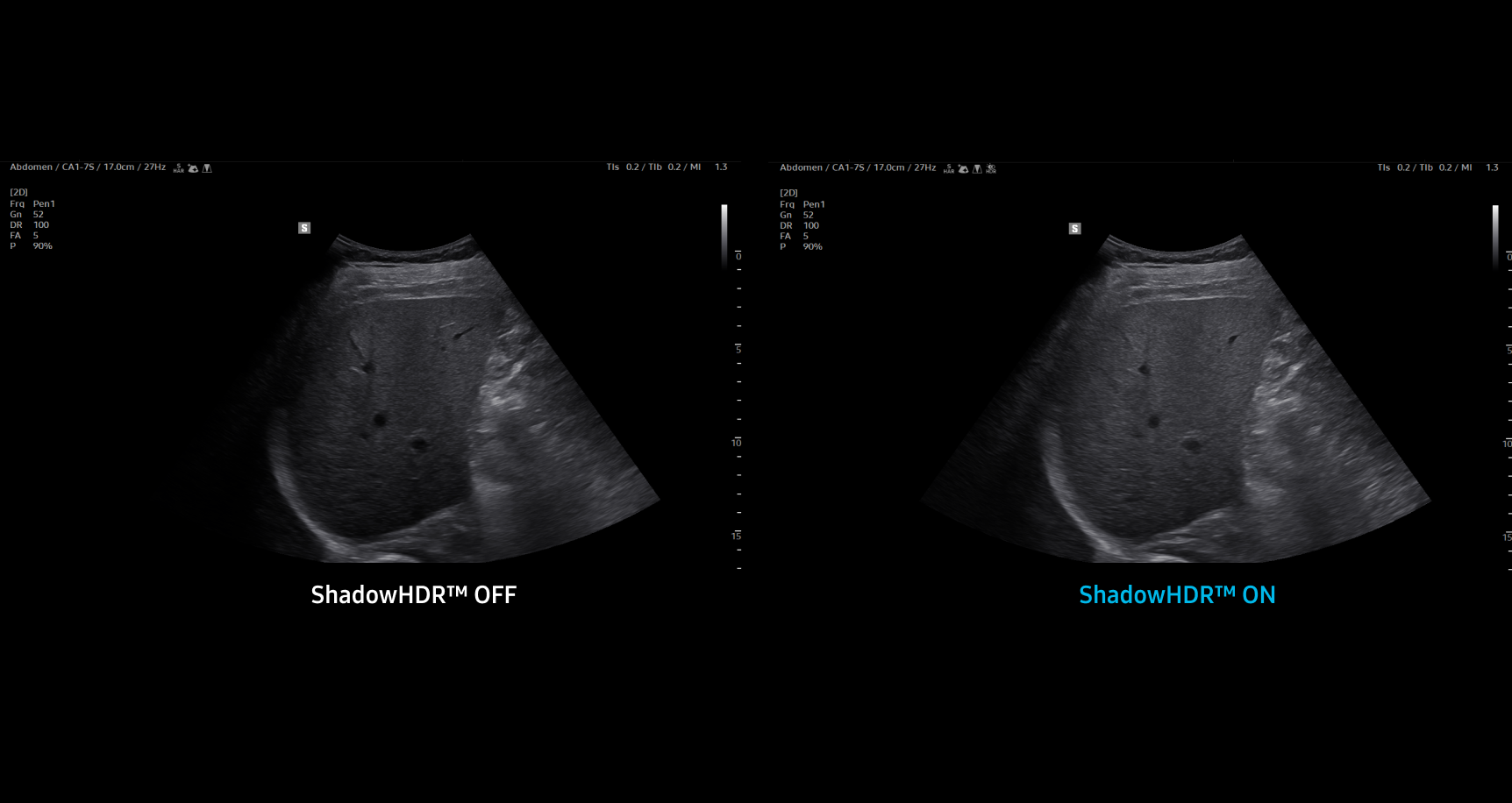 Side by side abdominal ultrasound images of the liver showing ShadowHDR OFF on the left with darker shadows and less detail and ShadowHDR ON on the right with reduced shadows and enhanced tissue visibility