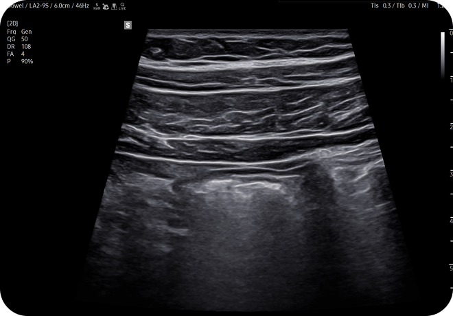 Ultrasound scan showing a cross-sectional view of the bowel in grayscale with layered intestinal walls and surrounding soft tissue