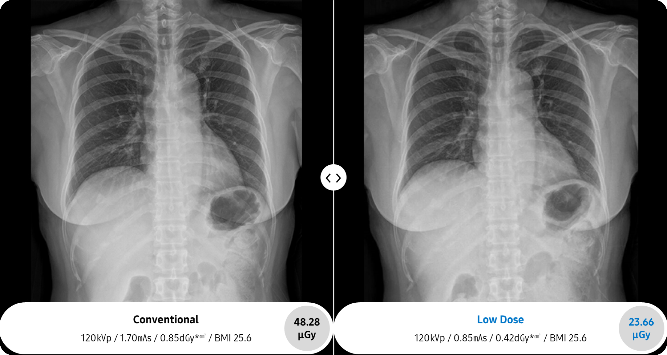 X-ray image of an adult chest taken by GC85A x-ray machine