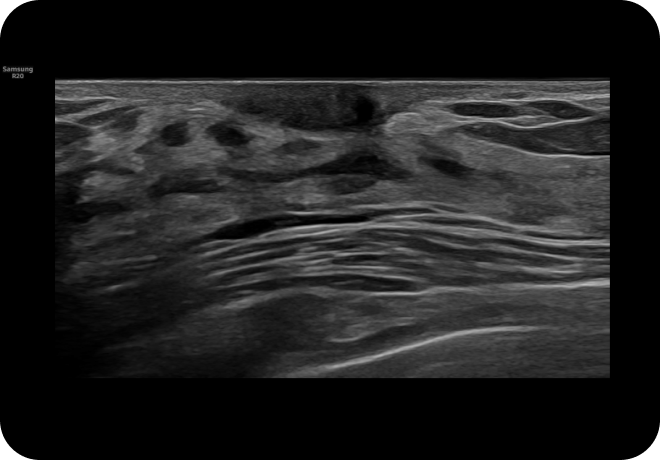 Ultrasound scan showing a cross-sectional view of soft tissue structures in grayscale with distinct layers and textures