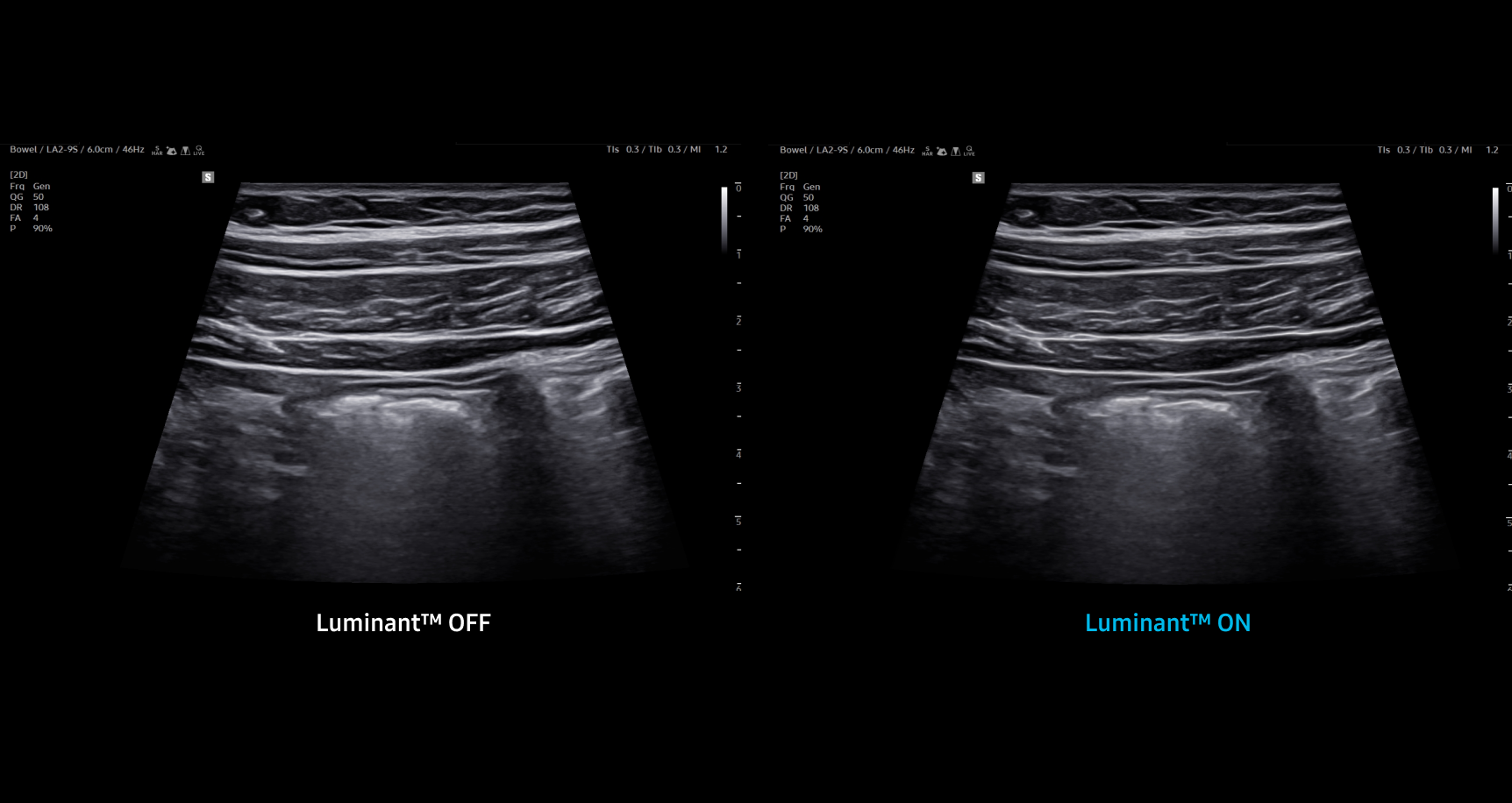Side by side bowel ultrasound images showing Luminant OFF on the left with lower brightness and contrast and Luminant ON on the right with enhanced brightness improved contrast and clearer tissue layers