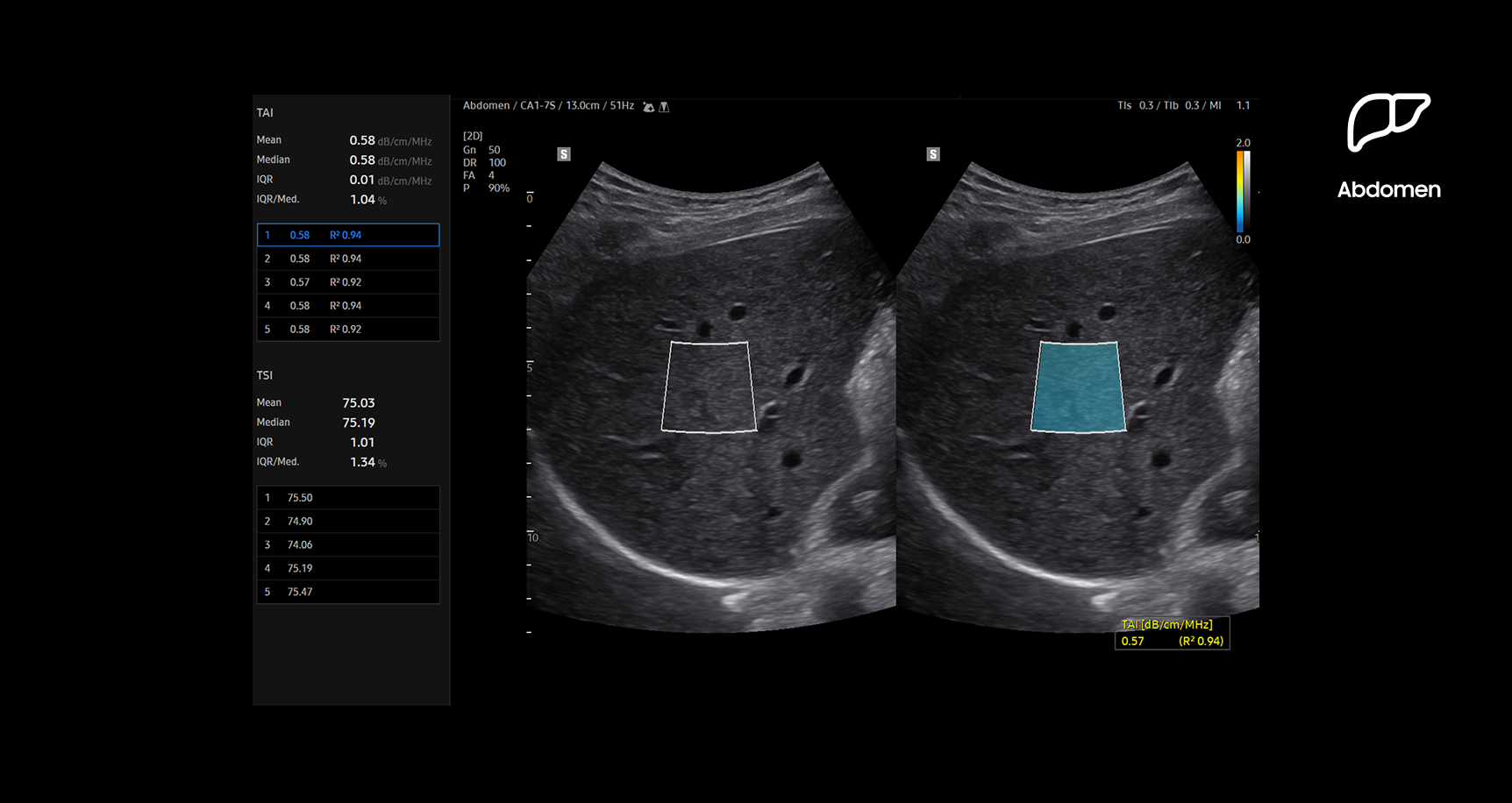 Dual-panel ultrasound image of the liver using TAI (Tissue Attenuation Imaging) showing regions of interest outlined in rectangles with quantitative measurements displayed to assess steatotic liver changes