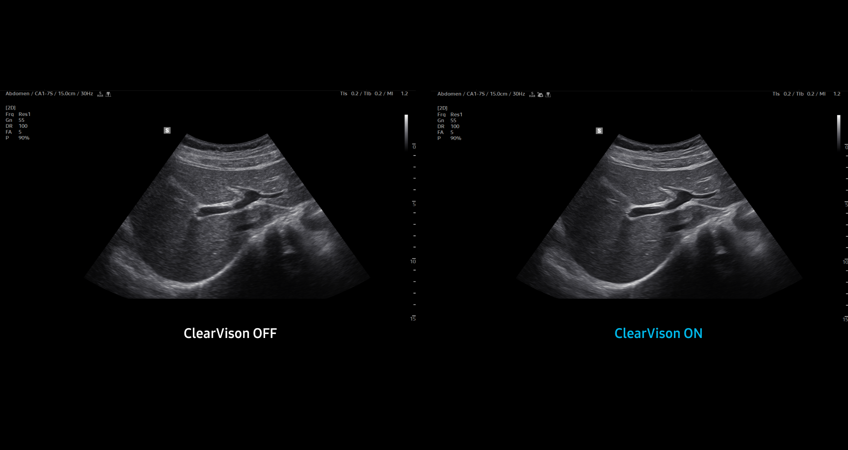 Side by side abdominal ultrasound images showing the liver and bile ducts in grayscale with the left image labeled ClearVision OFF appearing grainier and less defined while the right image labeled ClearVision ON shows clearer sharper tissue structures and improved contrast