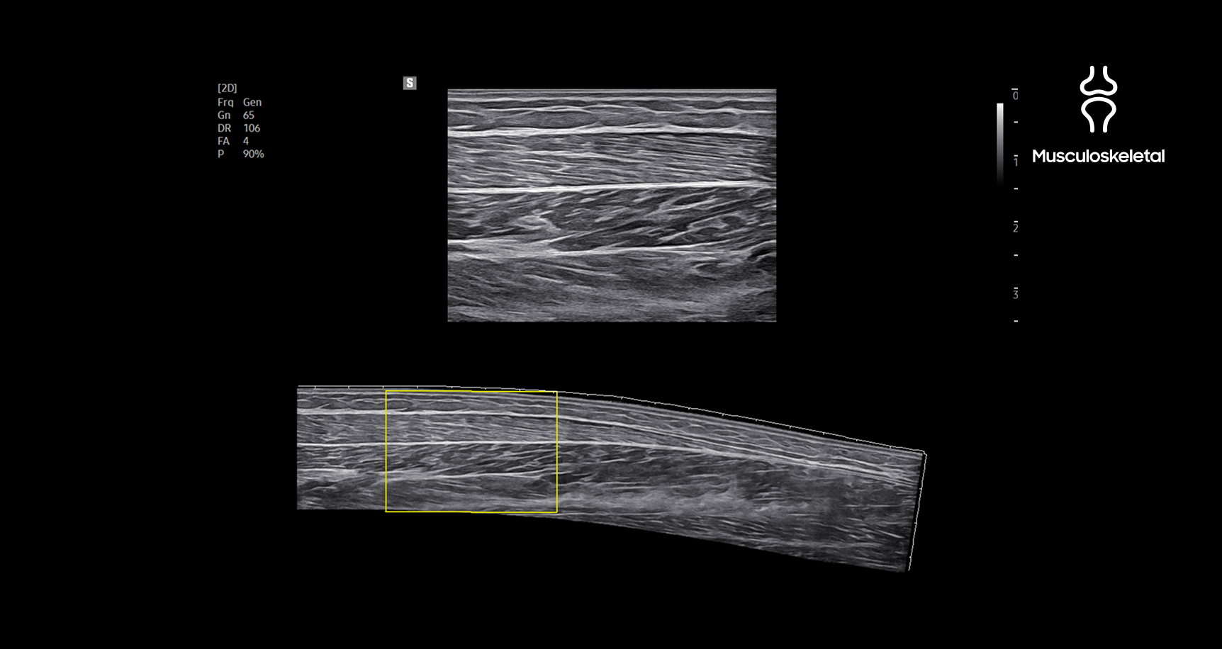 Musculoskeletal ultrasound image using Panoramic imaging showing an extended field of view with a wide linear scan and a highlighted yellow rectangle indicating the scanned region supporting angular and linear transducer data acquisition