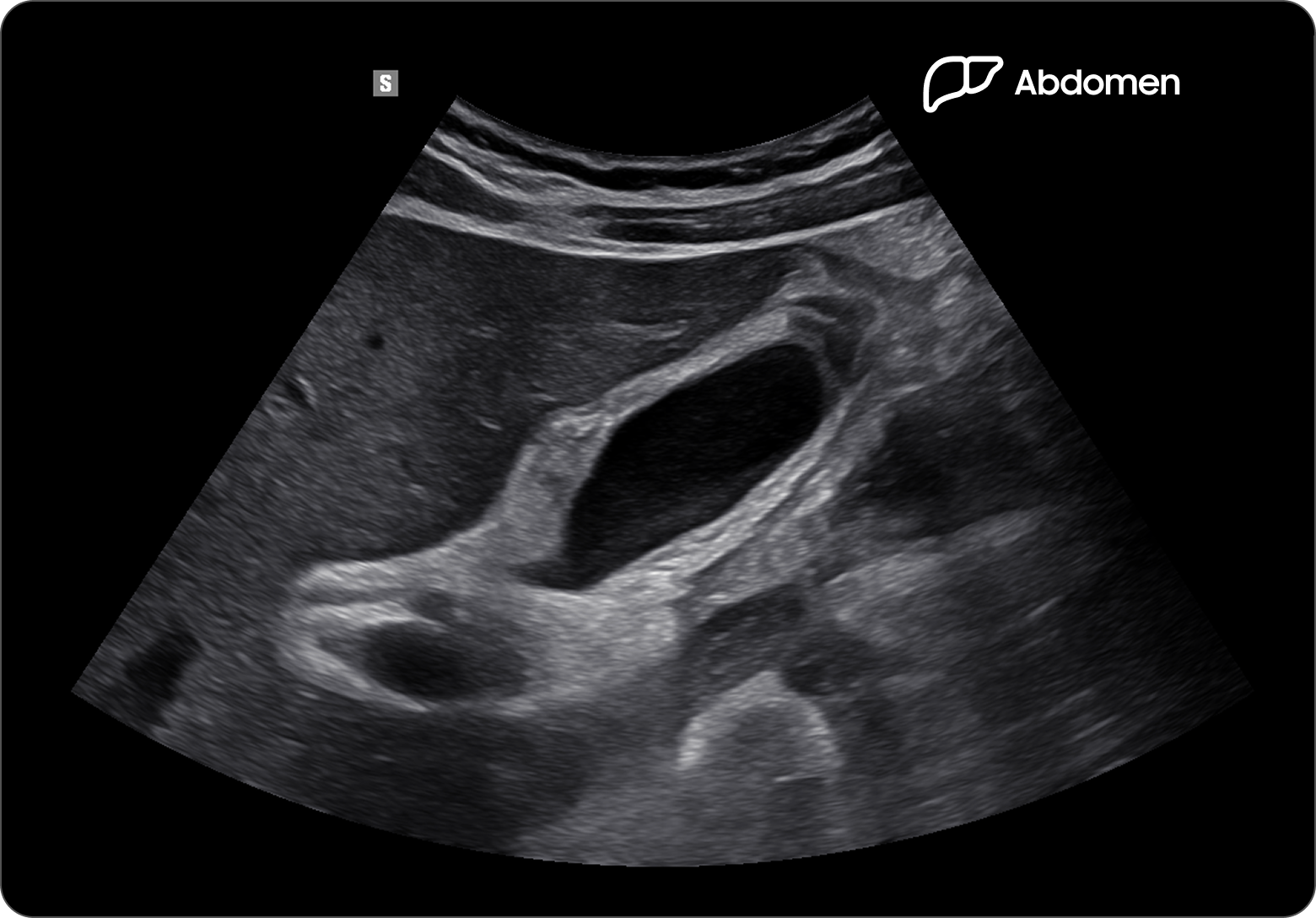 Ultrasound image of the gallbladder showing signs of acute cholecystitis with thickened wall and stones