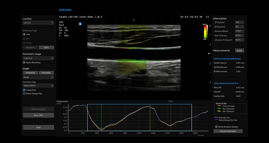 ArterialAnalysis tool displaying advanced vascular assessment with highlighted carotid artery walls and corresponding pulse wave velocity measurements for early detection of arterial stiffness