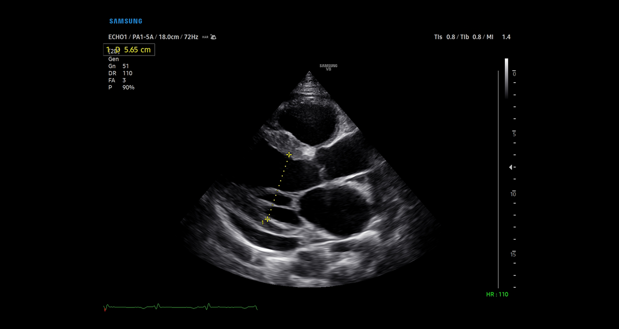 text: High-resolution pericardial effusion PLAX view captured with Samsung cV Ultrasound system showing precise cardiac measurements and diagnostic clarity