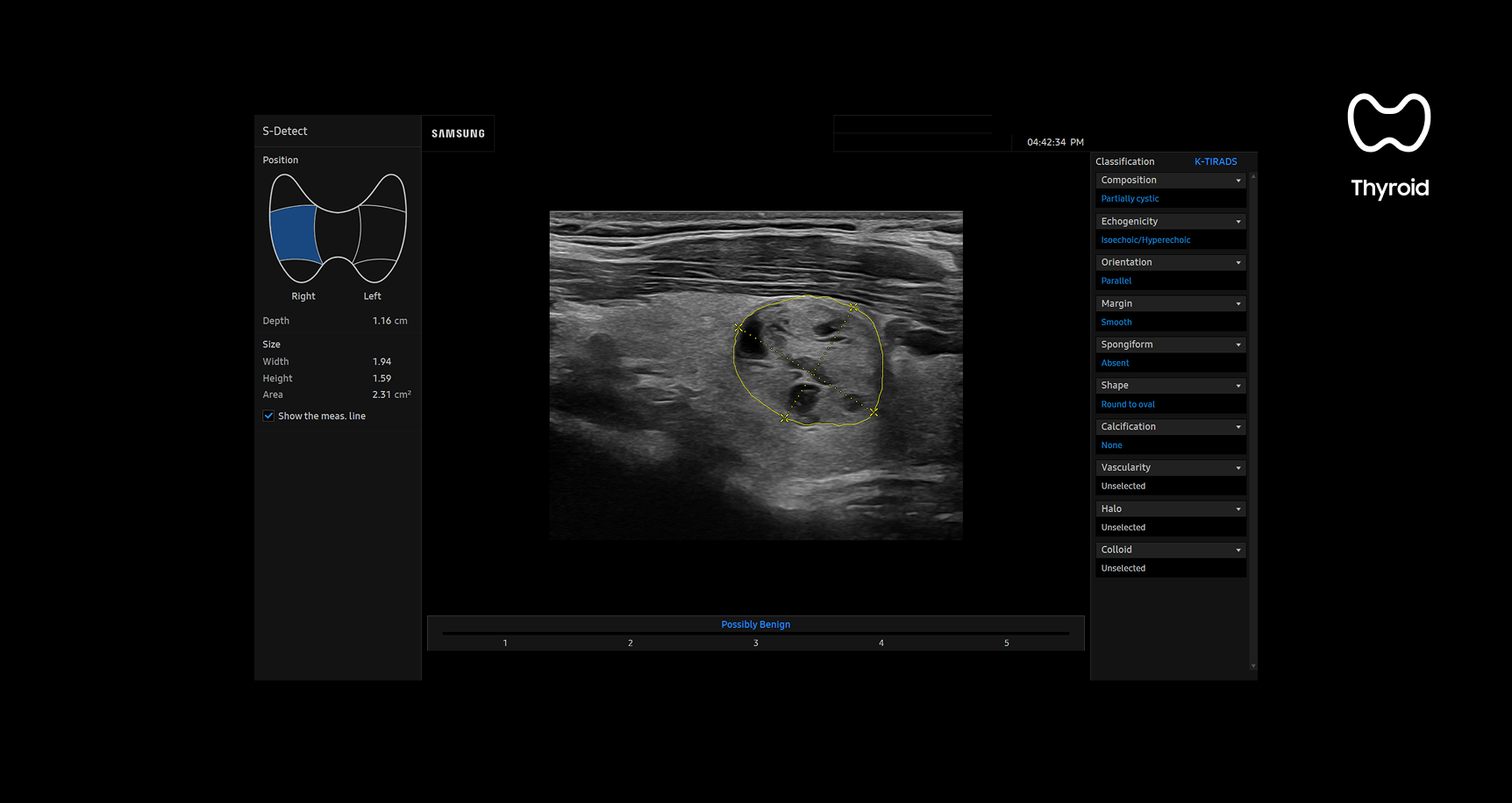 Thyroid ultrasound image using S-Detect showing a lesion outlined in yellow with analysis data and standardized classification based on ATA BTA EU-TIRADS K-TIRADS and ACR TI-RADS guidelines to assist diagnosis and reporting